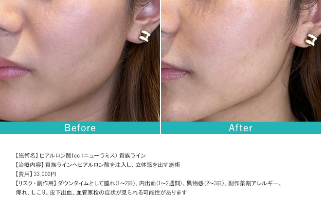 3点、ヒアル2点、ニュイ ヒアルロン酸注射（ニューラミス）0.5cc（ほうれい線など3部位