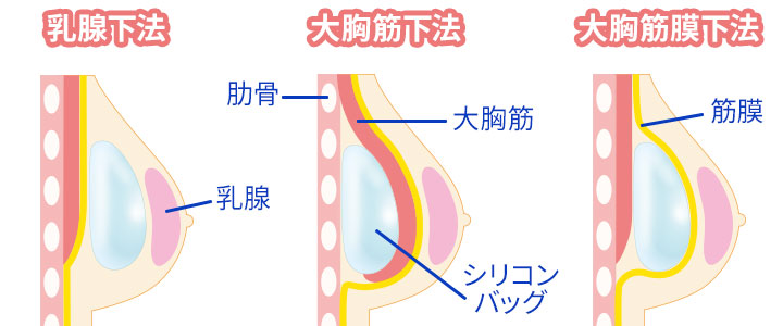 シリコン乳房　細身の方に　