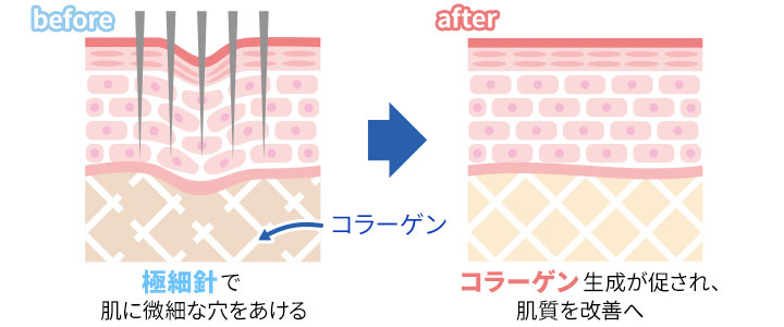 ダーマペンとは