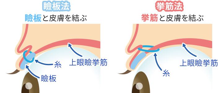 埋没法の主な種類（瞼板法と挙筋法）