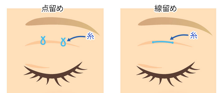 埋没法の主な種類（点留めと線留め）