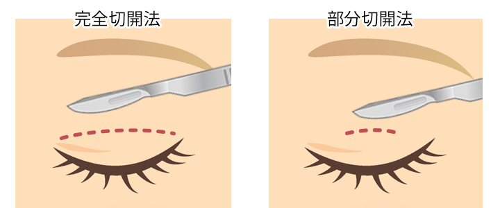 完全切開法と部分切開法
