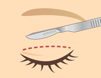 二重整形（切開法）とは