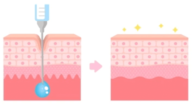 ボトックスイメージ