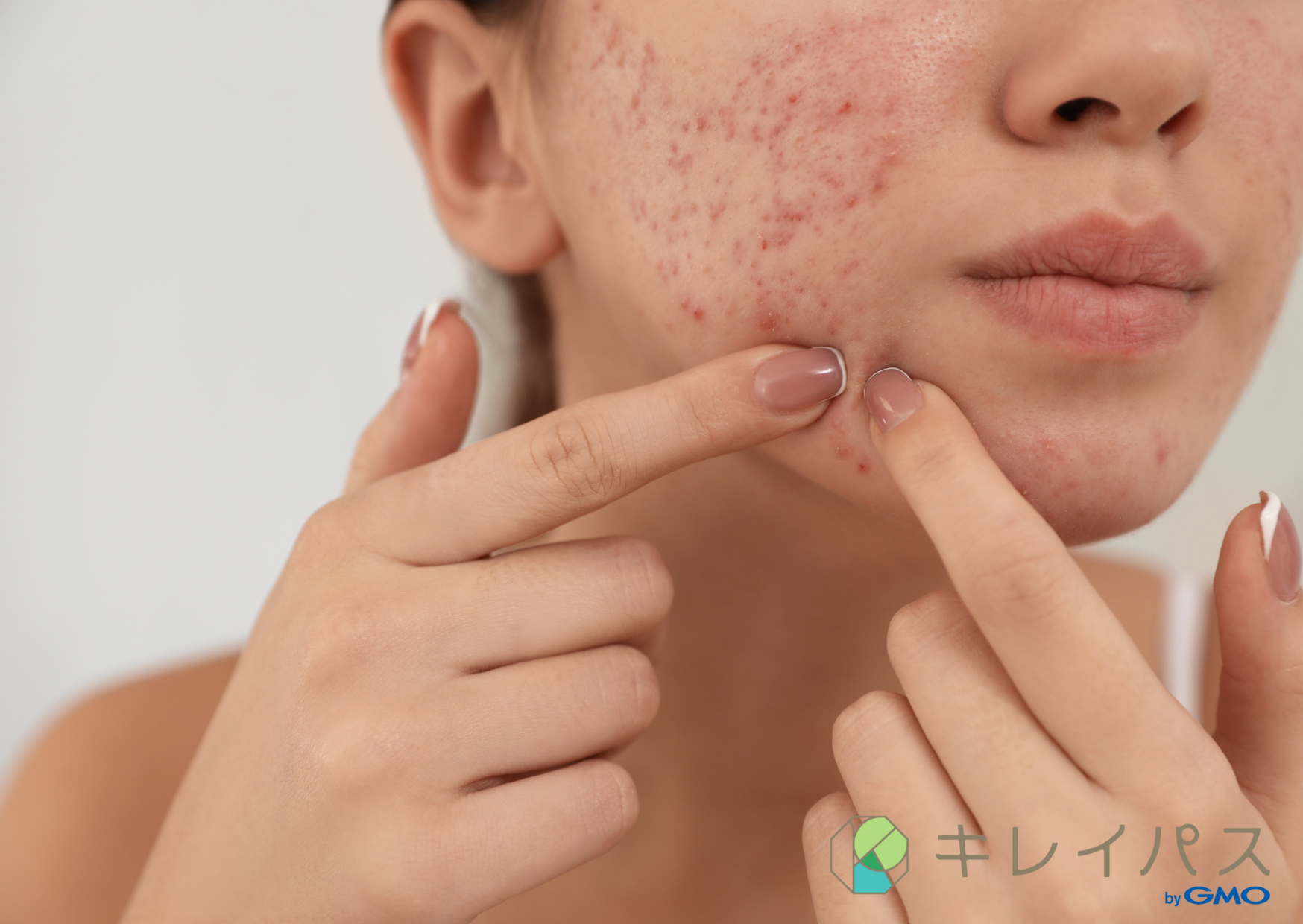 水光注射(毛穴・ニキビ跡)