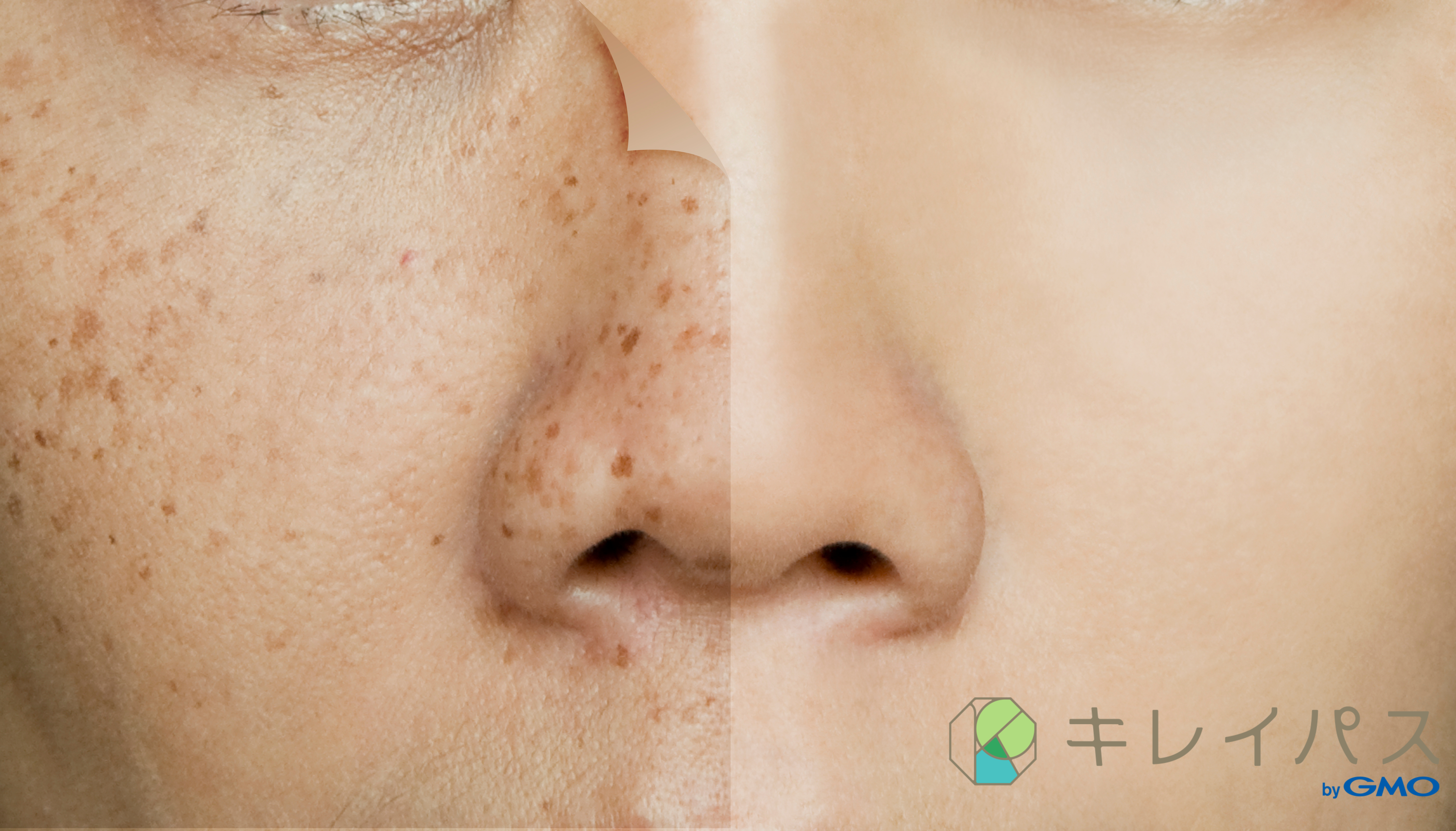 シミ取りの効果は？リアルな口コミ多数